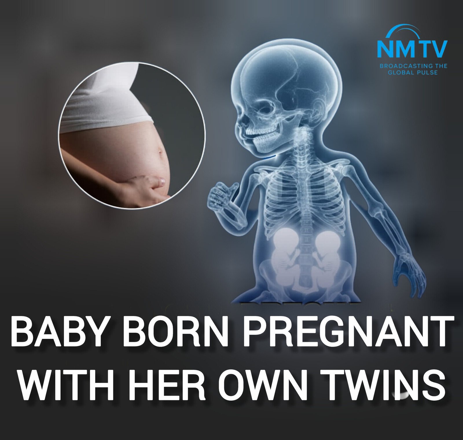Miracle and a Medical Mystery: Baby “Pregnant” with Twins in India